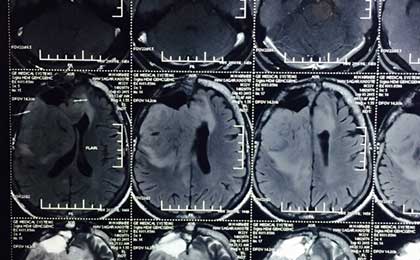 Gliomas of Brain
