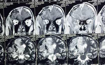 Gliomas of Brain