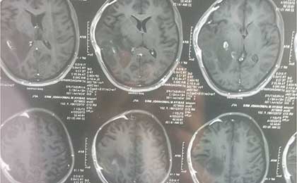 Gliomas of Brain