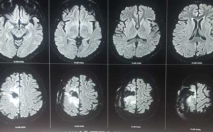 Gliomas of Brain