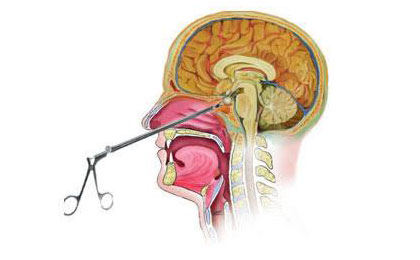 Removed the big iron piece