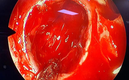 Removed the big iron piece