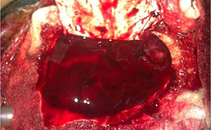 Subdural Haematoma